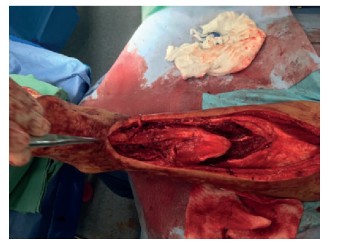 V-Y posun s možností uzavření defektu end to end
suturou<br>
Fig. 2: V-Y tendon plasty capable of closing the defect
using end-to-end suture