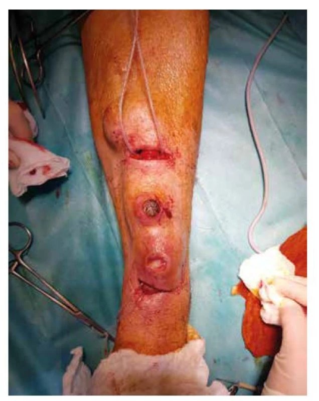 Zajištění žíly AVF<br>
Fig. 2: AVF – vein isolation