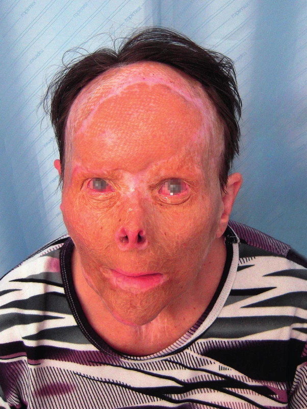 One year after the surgery – front view
