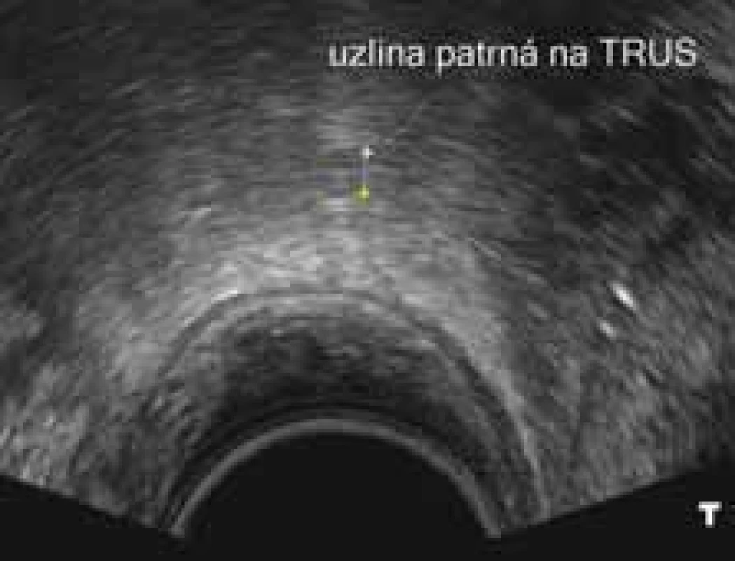 Uzlina při TRUS vyšetření. Žádný
znak ani velikost nesvědčí pro patologickou uzlinu.
TRUS – transrektální sonografi e