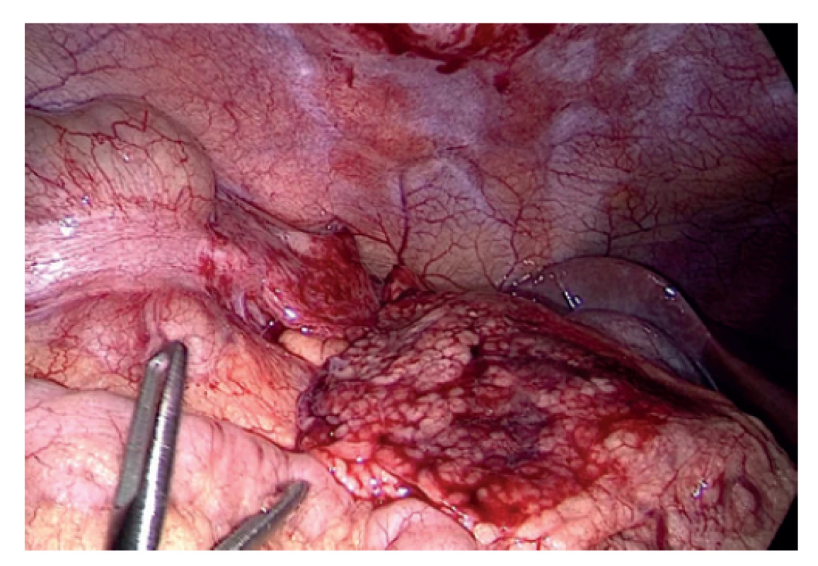 Uvolněné torkvované omentum<br>
Fig. 1: Released torqued omentum