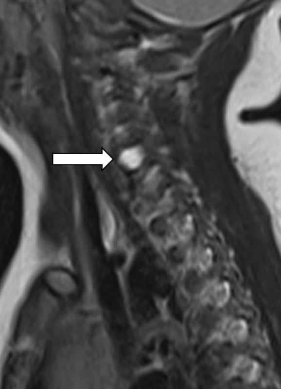  MRI – T2 vážený TSE obraz, sagitální rovina v úrovni intervertebrálních foramin. T2 hypersignální pseudomeningocele v oblasti foramina C5–6 bez diferencovatelného kořene C6. <br>
Fig. 5. MRI – T2 weighted image, sagital plane at the level of intervertebral foramina.
T2 hyperintense pseudomeningocele at C5–6. No C6 root can be identified.