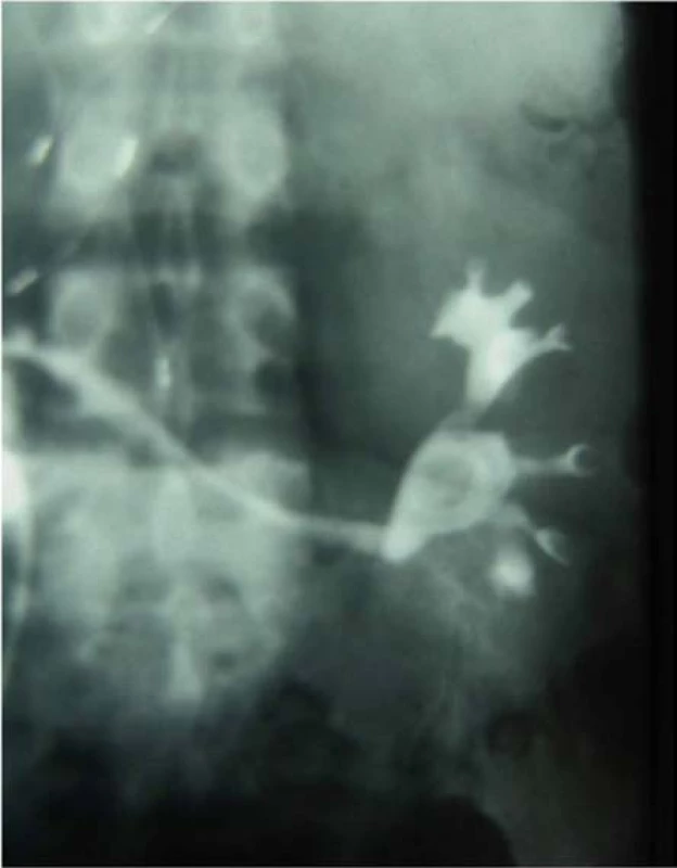 Močovod transplatovanej obličky všitý do
ileálneho konduitu<br>
Fig. 11. Ureter of the transplanted kidney implanted
into an ileal conduit