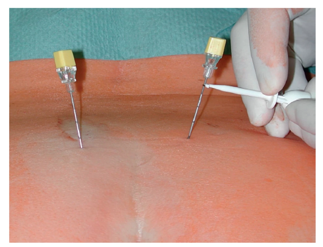 Stimulační elektrody zavedené do foramen sacrale
dorsale a zahájení stimulace<br>
Fig. 1: Sacral foramen needle positioning and initiation of
stimulation
