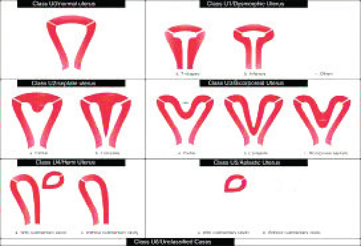 Klasifikace děložních malformací podle ESHRE/ESGE, 2013.<br>
Fig. 3. Classification of congenital uterine anomalies as described by the ESHRE/ESGE, 2013