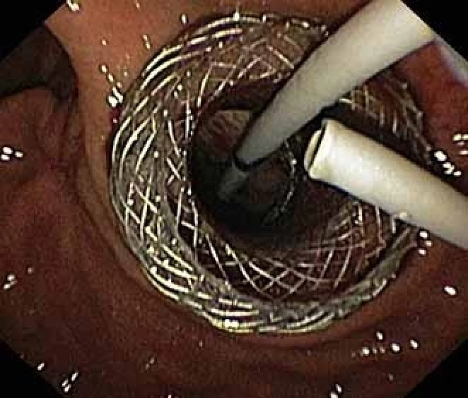HOT AXIOS™ stent a zavedený pojistný plastový double pigtail stent.<br> Fig. 5. A HOT AXIOS™ stent and a security plastic double pigtail stent.