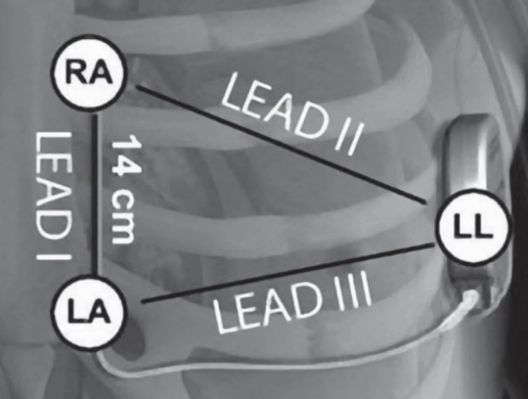 The placing of S-ICD system and sensing vectors: primary (Lead III), secondary (Lead II) and alternate (Lead I). The ECG lead wire colors corresponds
to the traffic light colors: RA = red, LA = yellow, LL =
green [6].