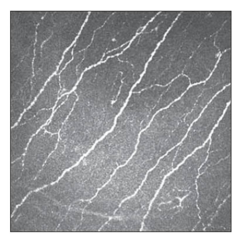 Fyziologická konfigurace subbazálního
plexu snímaná Heidelberg Retina
Tomograph III.<br>
Fig. 2. Physiological configuration of
subbasal plexus as captured by Heidelberg
Retina Tomograph III.