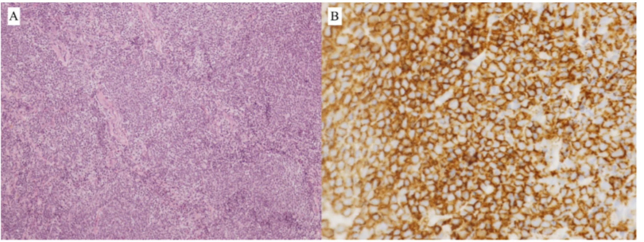 Fig. 3. Patient 1 – B-NHL type MCL, biopsy finding:<br>
A) Infiltration of soft tissues by dense, pseudonodular growing tumorous lymphoproliferation from<br>
small to medium-sized lymphoid cells (HE, enlargement 100x)<br>
B) Immunohistochemical positivity of CD20+ marker in tumour cells (enlargement 400x)