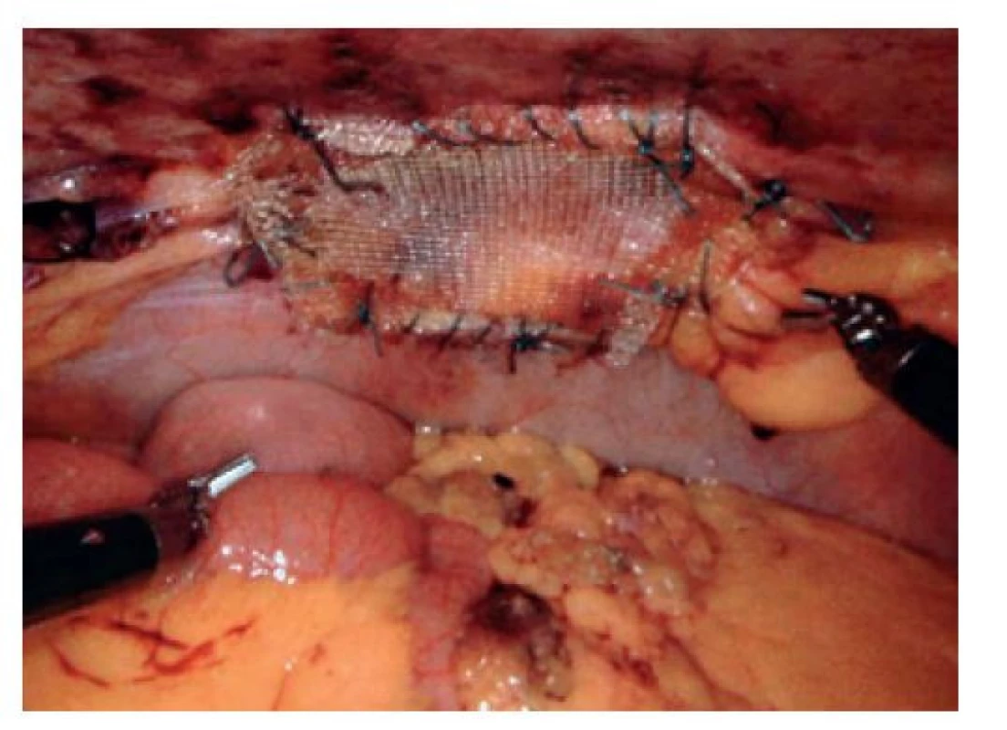 Robotická operace kýly v jizvě<br>
Fig. 7: Robotic hernia mesh repair