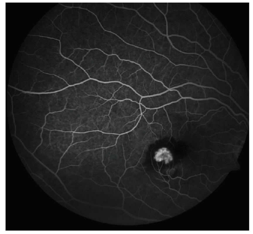 Fluorescein angiography (FAG) OD: active classic choroidal
neovascularisation in juxtafoveolar area