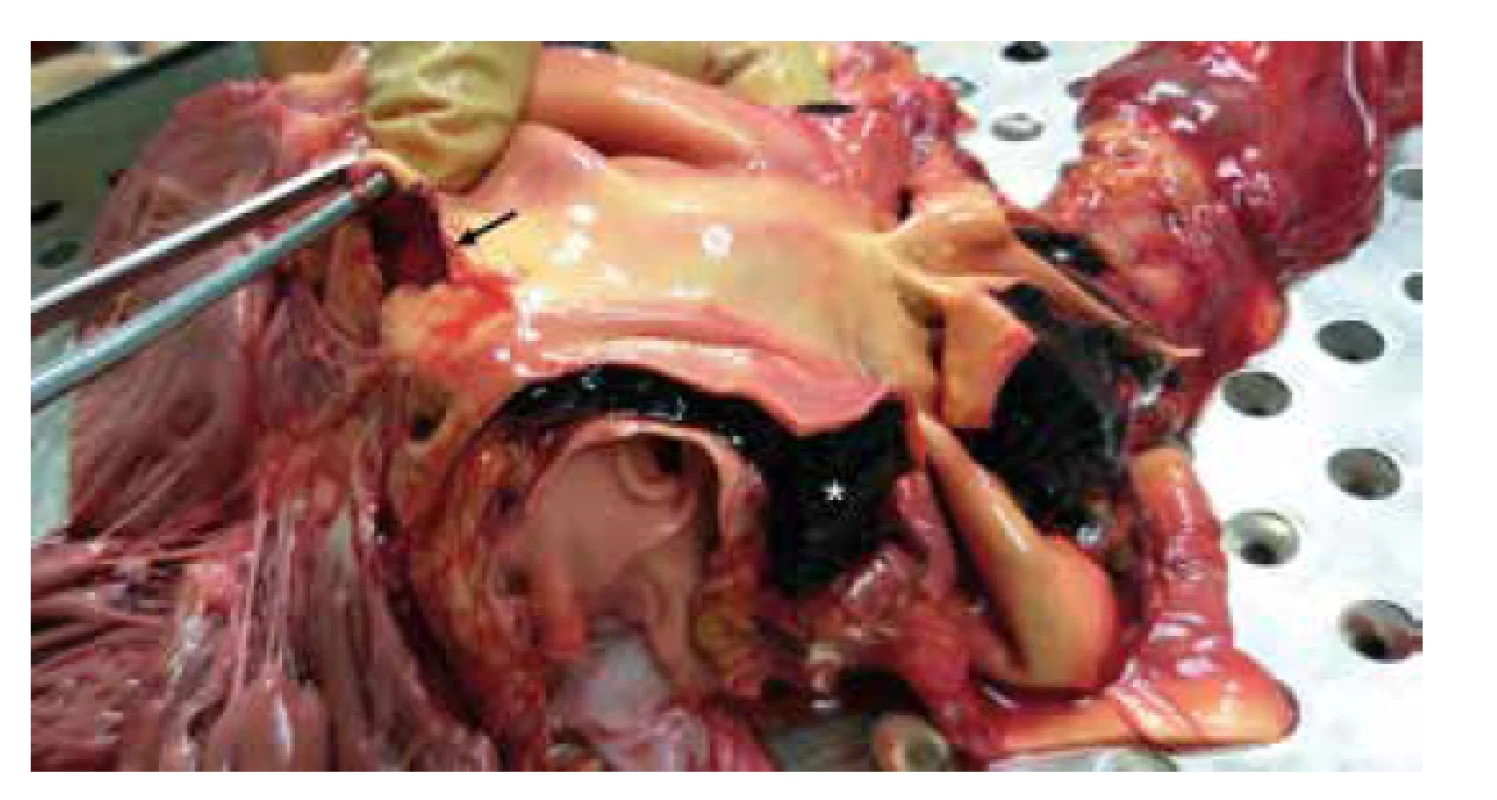 Trhlina v cévní stěně (šipka) a intramurální hematom (hvězdička). <br>
Fig.2. Tear within a vessel wall (arrow) and intramural hematoma (star).
