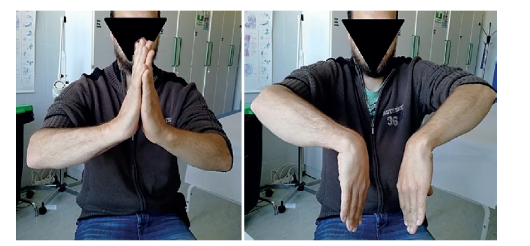 Rozsah hybnosti 12 měsíců od dermatofasciotomie<br>
Plná flexe a extenze ve srovnání s kontralaterální stranou.<br>
Fig. 3: Range of motion 12 months after dermatofasciotomy<br>
Full flexion and extension compared to the contralateral side.