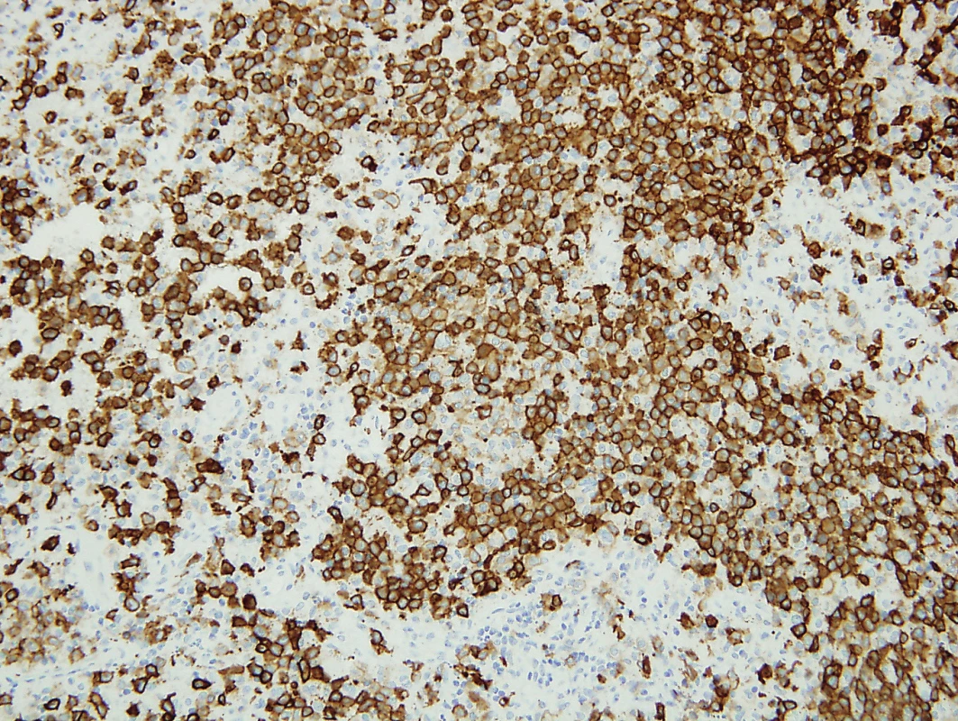 Langerhansovy bb. jsou imunohistochemicky silně pozitivní
s CD1a (200x)