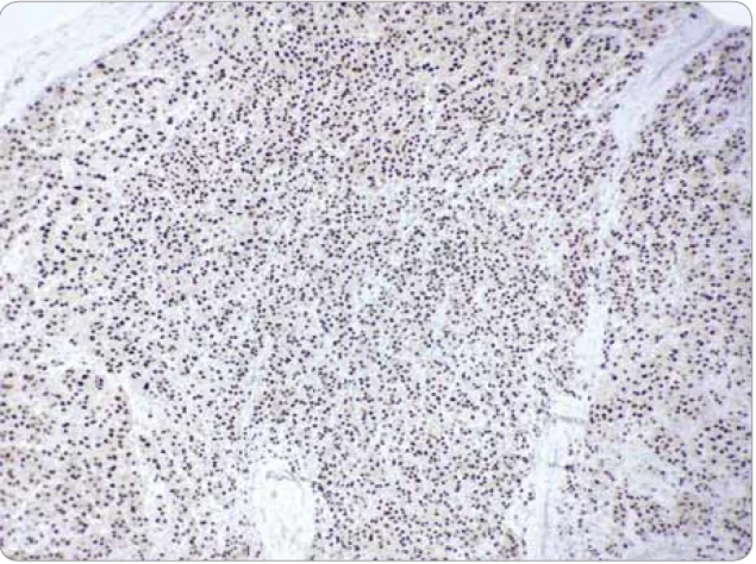 Imunohistochemická jadrová pozitivita nádorových buniek na TFE3 (zväčšenie 20×).
