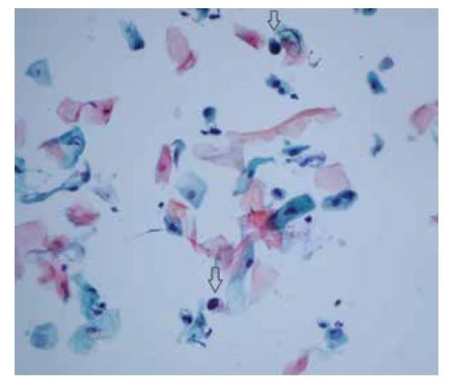 HSIL (high-grade skvamózní intraepiteliální léze)
– vzácné malé dysplastické buňky (šipky) skvamózního
původu s vysokým nukleocytoplazmatickým poměrem
a tmavým nepravidelným jádrem<br>
(barvení podle Papanicolaou, zvětšení 400x)