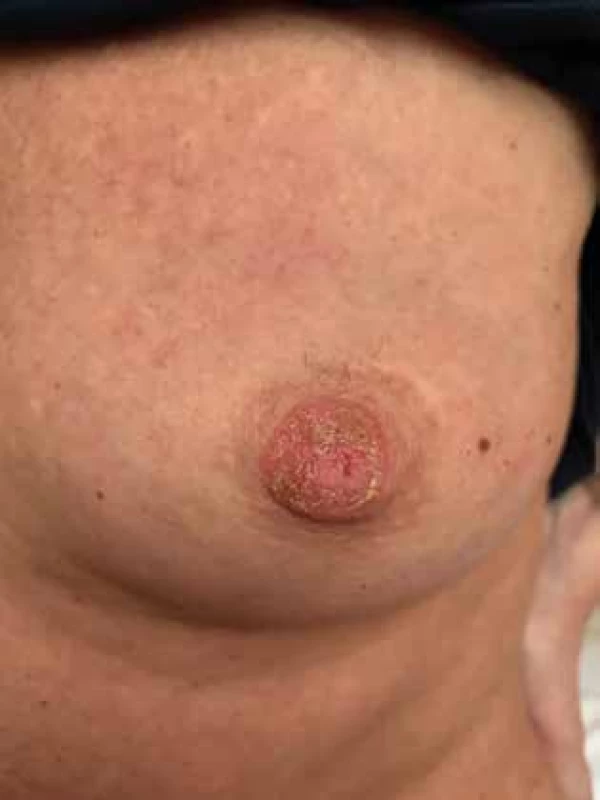 Pagetova choroba prsu − změny na mamile přecházející na kůži areoly <br>
Fig. 2: Paget’s disease of the breast − changes of the nipple spreading to the skin of the areola 
