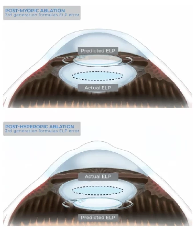 After myopic ablation, since the anterior curvature is
flattened, third-generation biometric formulas (SRK/T, Hoffer Q
and Holladay I) will erroneously predict a too-shallow postoperative
anterior chamber depth, and therefore an excessively anterior
effective intraocular lens position (top), and, conversely,
after hyperopic ablation, they will wrongly predict an excessively
posterior effective intraocular lens position (bottom)
