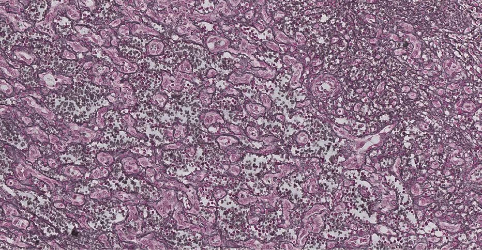 Průkaz Billrothových provazců: zvětšeno 200x, barvení Gomoriho trichrom (retikulin)<br>
Fig. 4. Evidence of the cords of Billroth: 200x magnification, dying Gomori trichrom (retikulin)