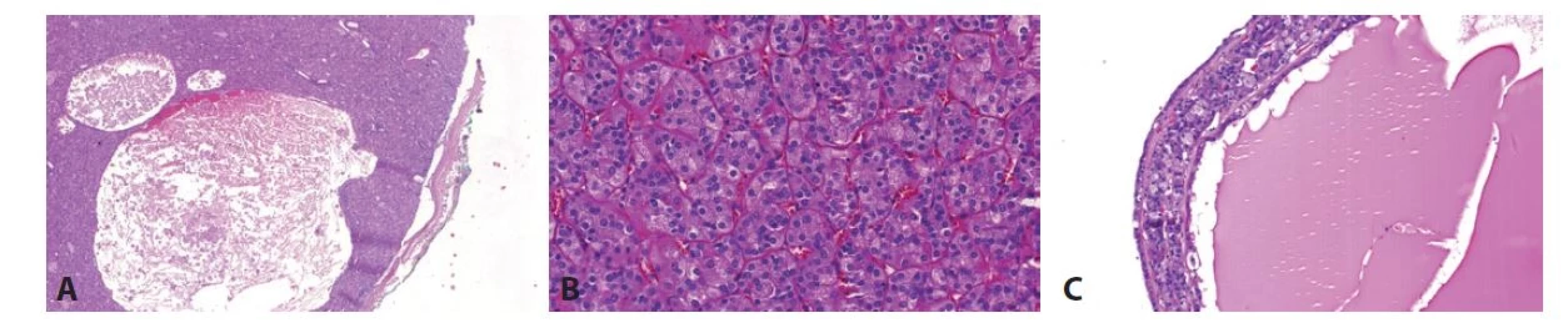 A. ESC je tumor s typickou kombinací solidní a cystické architektury. Obr. 3B. Solidní komponenta je tvořena objemnými buňkami s eosinofilní cytoplasmou
a „high-grade“ jádry. Obr. 3C. Cysty bývají vyplněné eosinofilní tekutinou, stěna cyst je složena z eosinofilních buněk, podobně jako solidní komponenta.