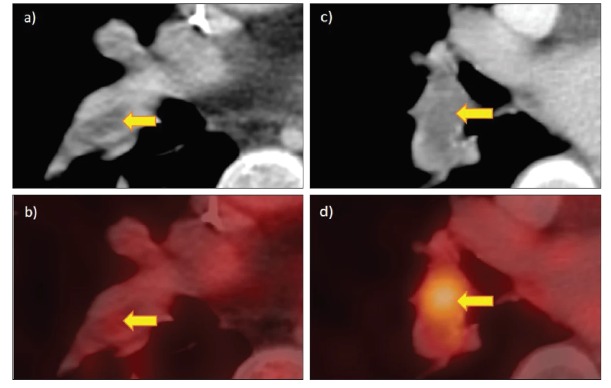 FDG PET/CT u plicní embolizace: a) a b) náhodný nález plicní embolizace u 58letého pacienta s tumorem pankreatu, cca 2denní
klinické příznaky před vyšetřením, emboly v tr. intermedius, bez zvýšené akumulace FDG, c) a d) náhodný nález plicní embolizace u 81leté
pacientky s hepatocelulárním karcinomem, asymptomatické, obtékaný embolus ve větvi plicnice pro pravý dolní lalok s okrajově zvýšenou
akumulací FDG.