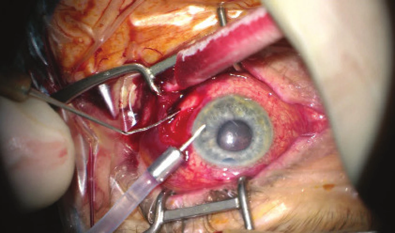 Initial phase of surgical procedure, evacuation of
haemorrhage by sclerotomy, release of intraocular hypertension,
anterior chamber created from viscose material,
eyeball later toned with infusion inserted into anterior
chamber. In the retrolental space, there is evident high
choroidal ablation in proximity behind the IOL. Image from
perioperative video – from surgeon’s view