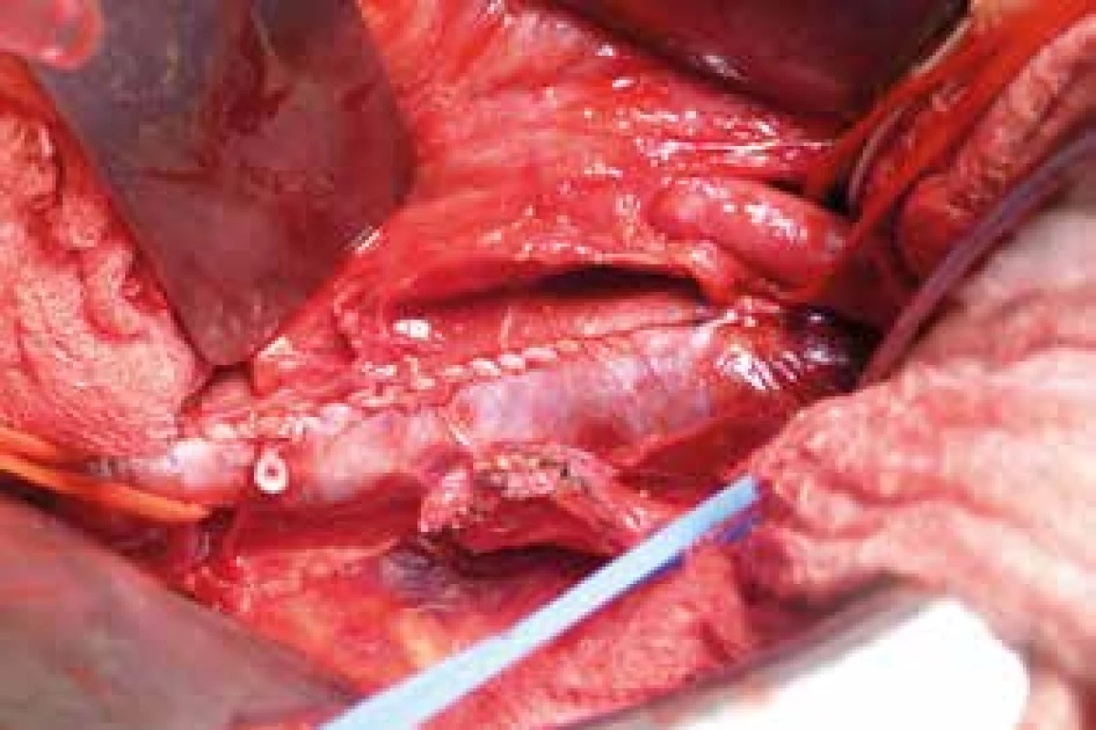 Primárna sutúra dolnej dutej žily <br>Fig. 2: Primary suture of the inferior vena cava