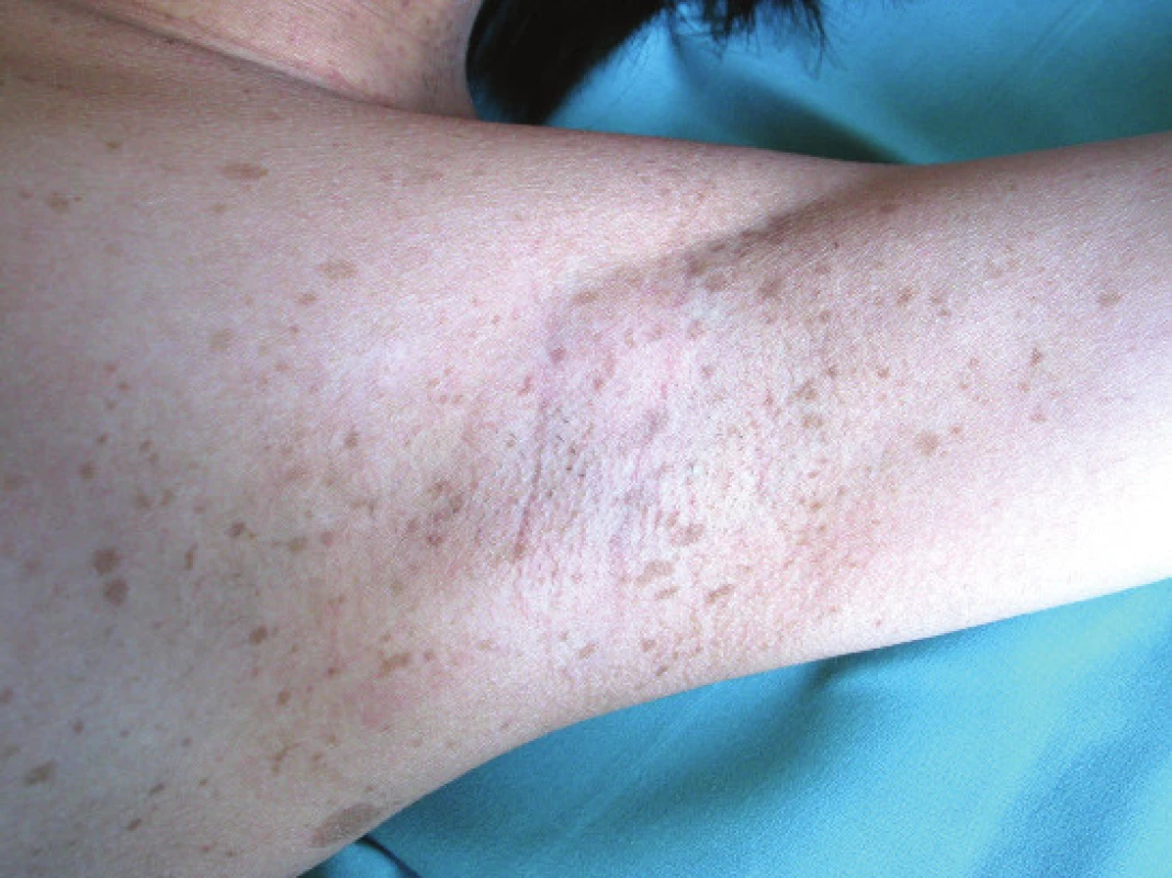 Freckling in underarm<br>
Source: Paediatric Clinic, Faculty of Medicine, Masaryk
University and University Hospital Brno