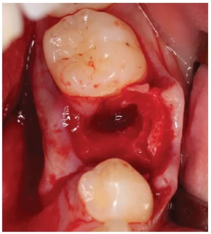 Stav po extrakci zubu 75
a vybavení retinovaného
premoláru 35. <br> 
Fig. 1.
The status after extractions
of tooth 75 and impacted
tooth 35.