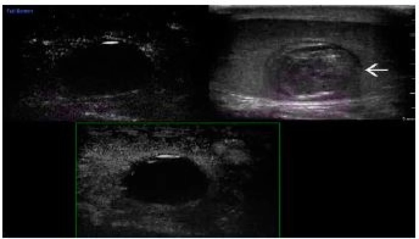 Epidermoid varlete.