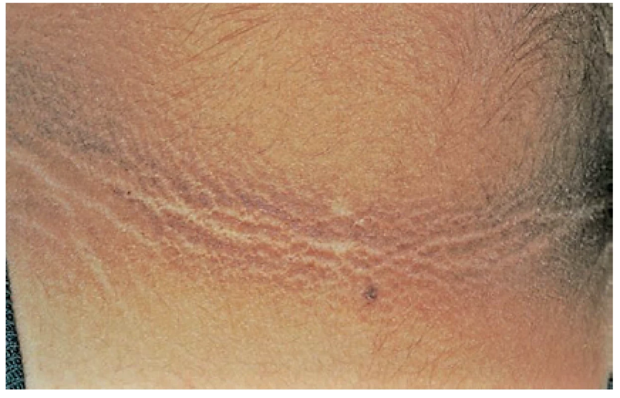 Acanthosis nigricans