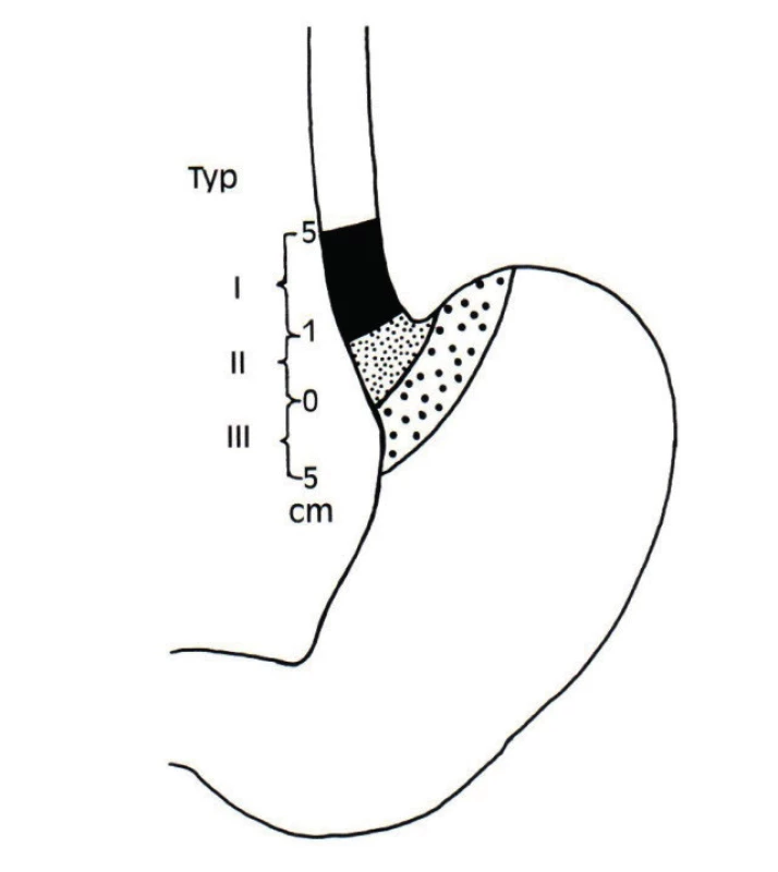 Siewertova klasifikace nádorů [3] v oblasti GEJ<br>
Fig. 1: Siewert classification of tumors [3] located at the
esophago-gastric junction