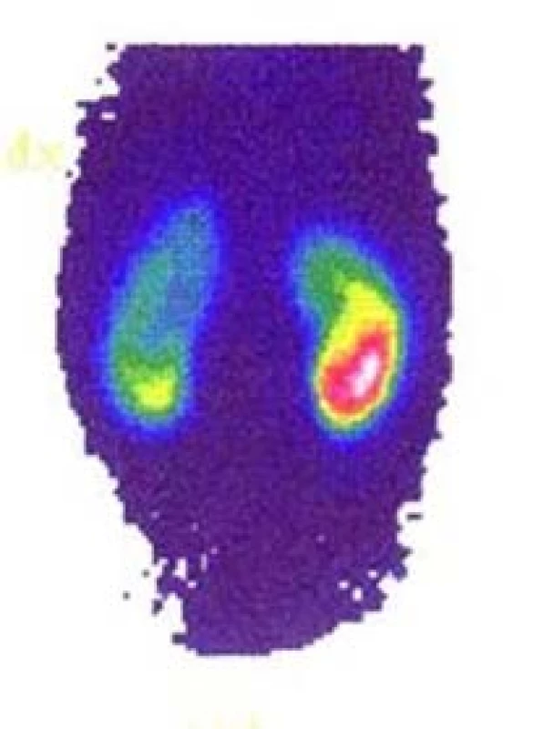 DMSA s oboustranným závažným postižením;
levá ledvina 46 %, pravá 54 % funkce (archiv
autora)<br>
Fig. 4. DMSA scan with severe bilateral scarring