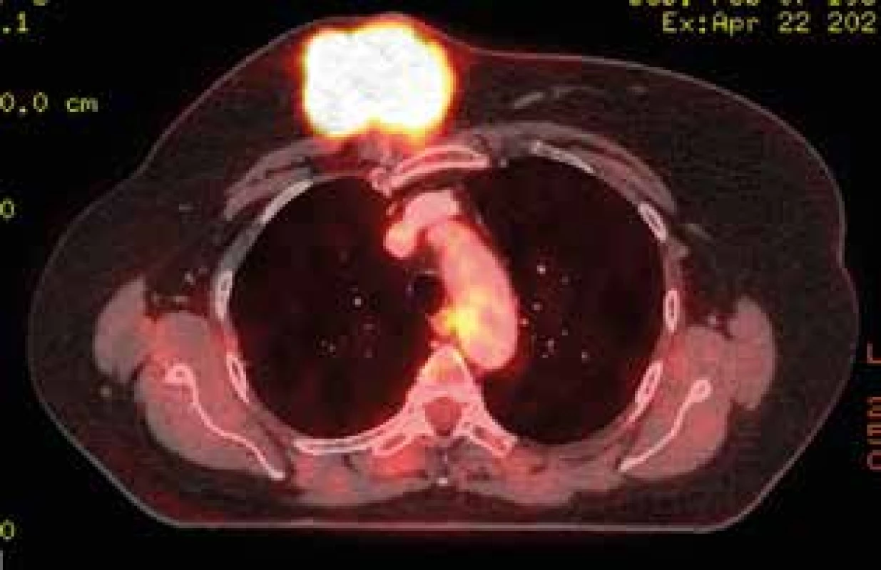 PET/CT, zmenšený nádor po neoadjuvantní léčbě <br>
Fig. 2: PET /CT, reduced tumor after neoadjuvant treatment