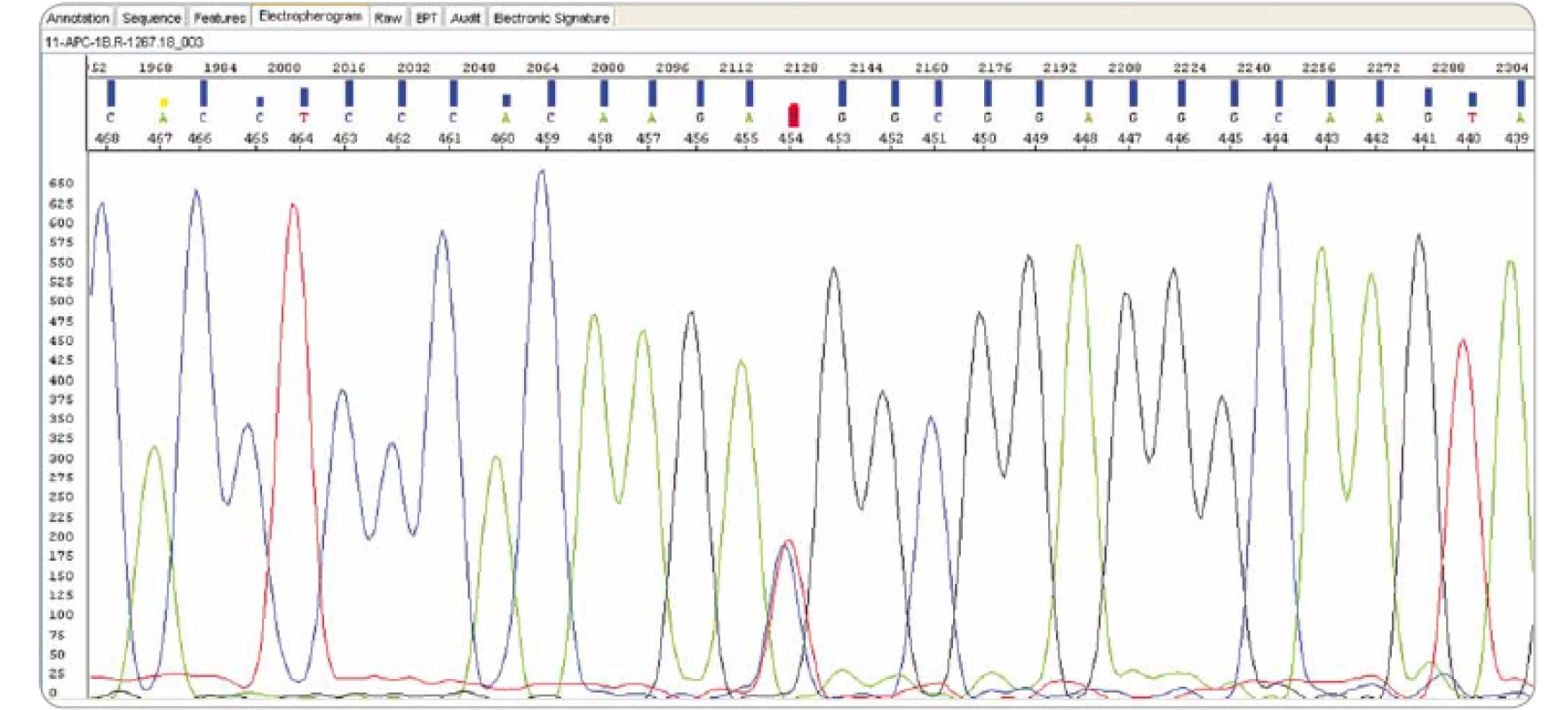 Sanger sequencing: APC NM_001127511.2: c.-191T>C (Masaryk Memorial Cancer Institute).