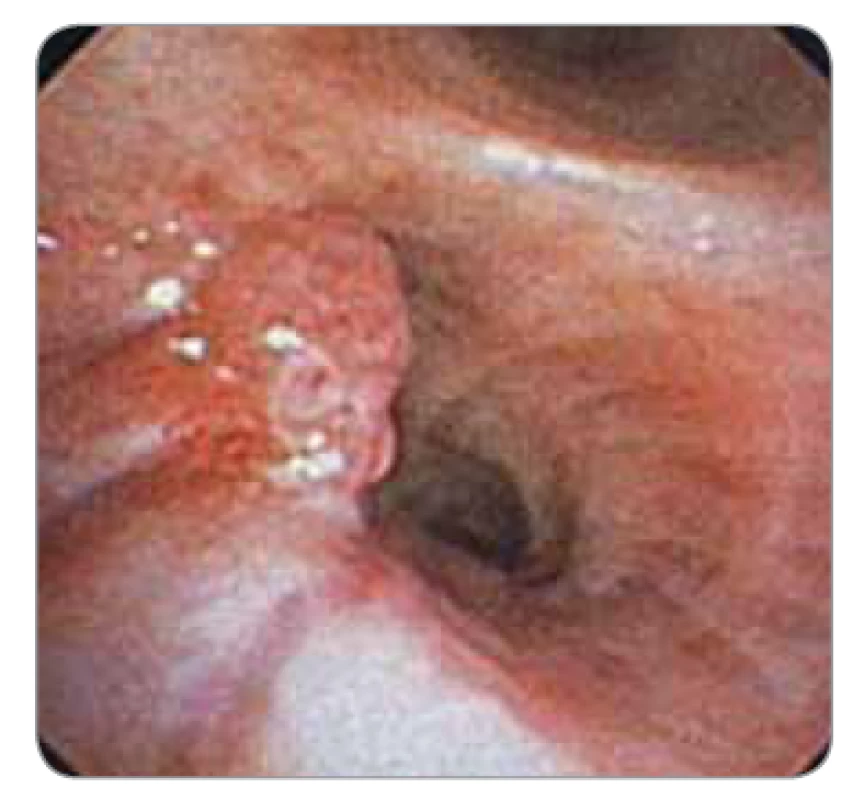 Endobronchiálně rostoucí nádor.