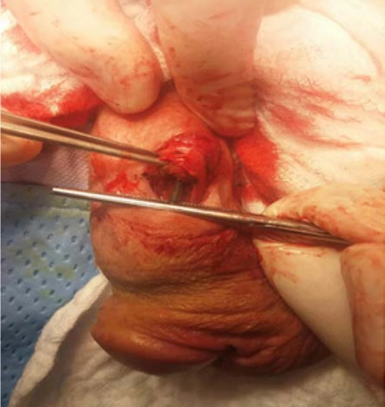 Peroperační identifikace a extrakce cizího
tělesa (hřebík 5 cm) z levého kavernózního tělesa<br>
Fig. 3. Intraoperative identification and extraction
of the foreign body (a 5-cm nail) from the left corpus
cavernosum