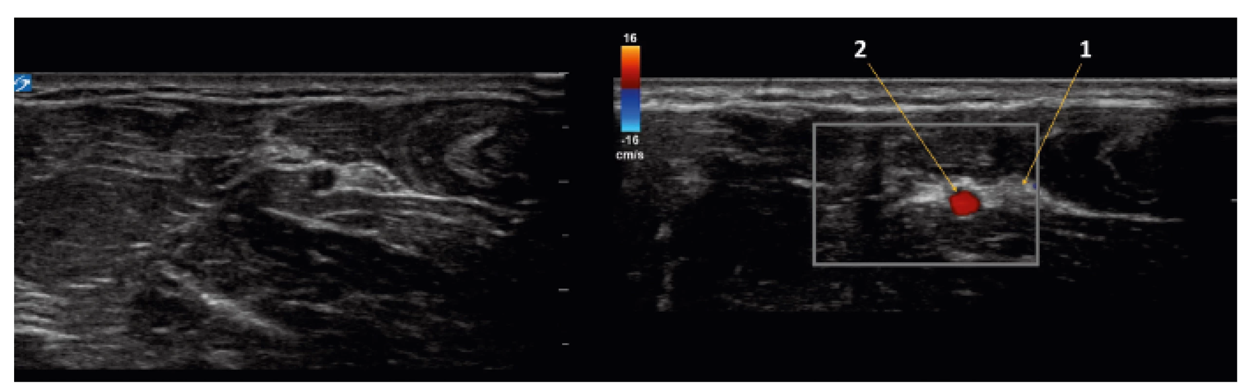 Ultrazvukový obraz (colour doppler) ulnární části středního předloktí
1 – ulnární nerv, 2 – ulnární tepna ve společné fascii mezi flexory ruky