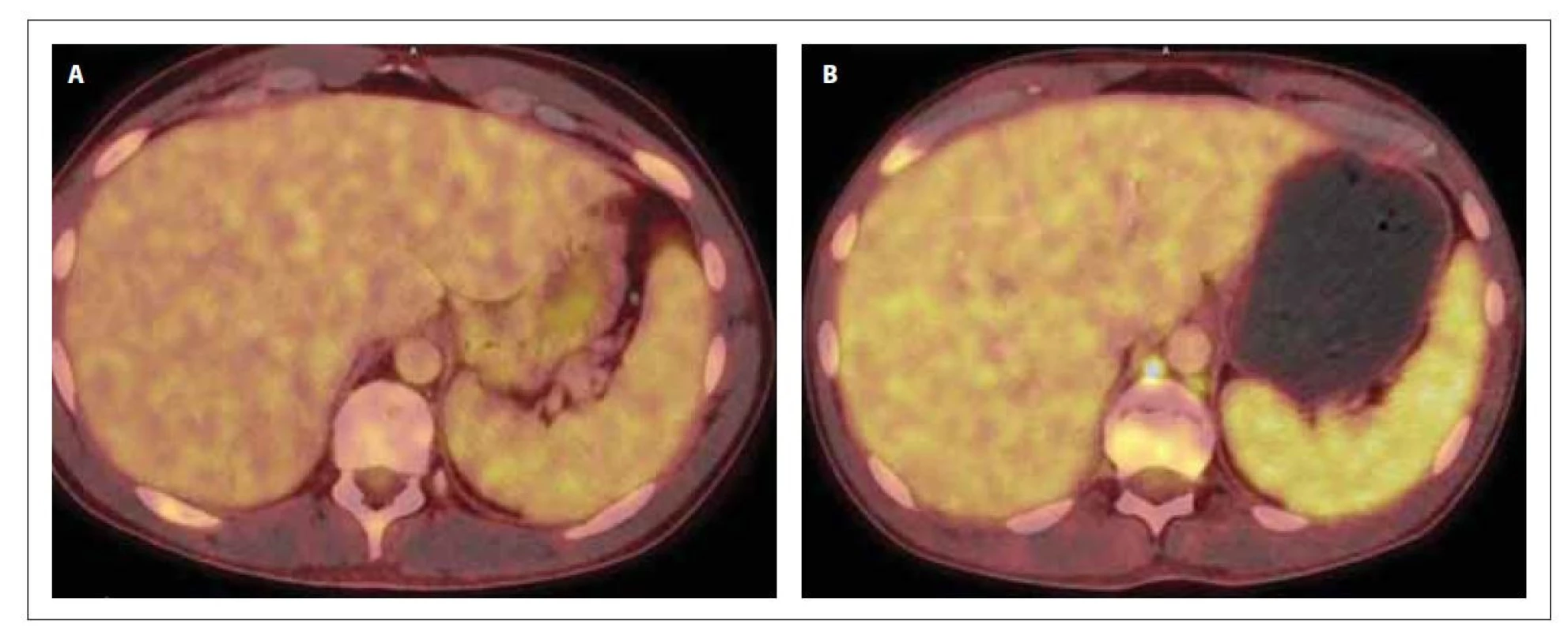 PET/CT sleziny v době diagnózy (A) a po 1. konsolidaci (B). Slezina bez patologického nálezu (A) a s prokázaným
hypermetabolizmem 18F-FDG (B) difuzně ve slezině vel. 134 x 39 x 128 mm (SUVmax 4,6), bez ložiskových změn
a ve 2 lymfatických uzlinách retroperitonea.