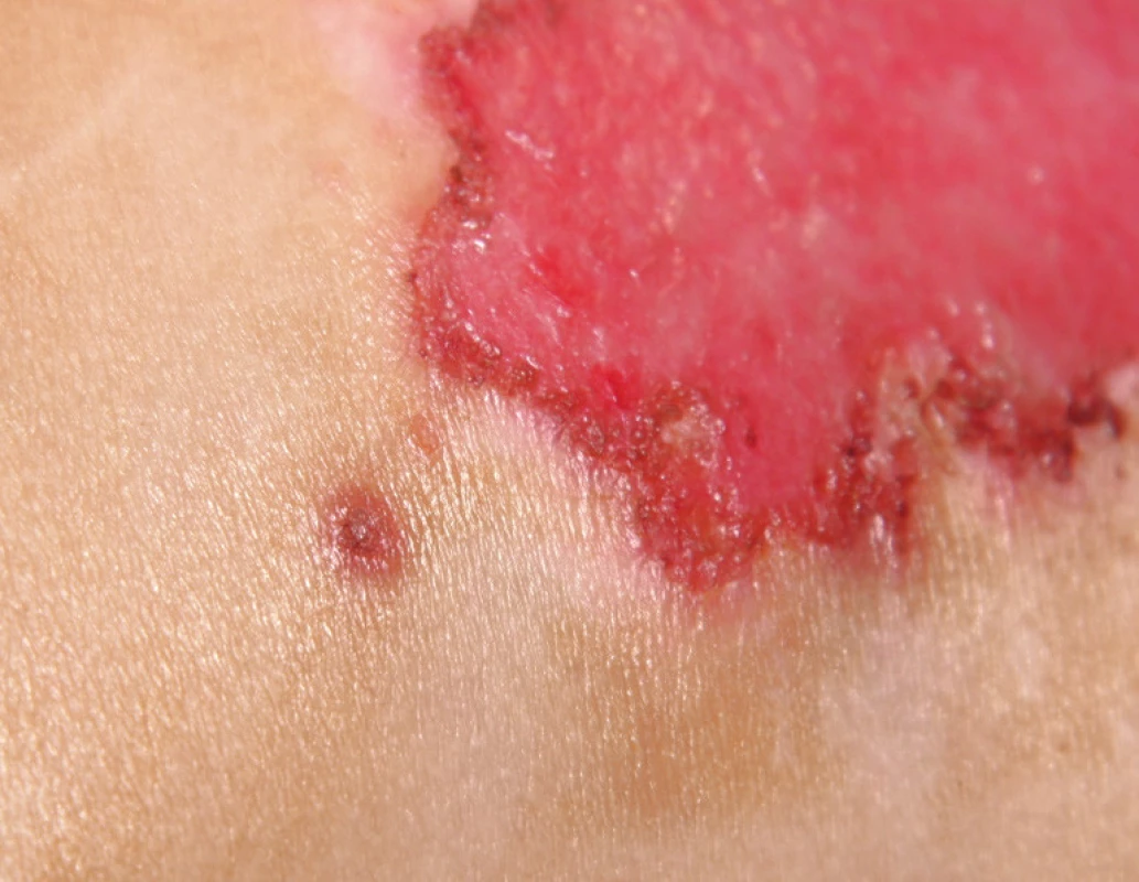 Post-burn day 18, after five days of acyclovir therapy:
herpetic skin lesions healing spontaneously