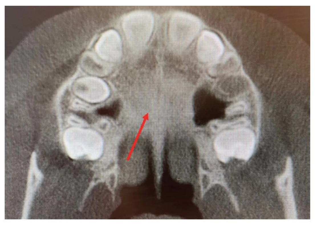 Patrový šev označený
červenou šipkou
na CBCT – stadium C
(zdroj: archiv ortodontického
oddělení FN Motol)<br>
Fig. 2 Palatine suture marked
with a red arrow on the
CBCT – stadium C
(source: archive of the
orthodontic department of the
Motol University Hospital)