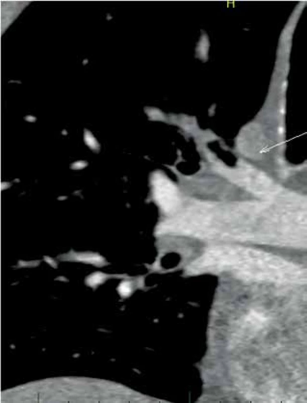 CT angiografie, šipka ukazuje plynovou bublinu 
ve větvi plícnice<br>
Fig. 1: CT angiography, the arrow indicates an air bubble 
in a pulmonary artery branch