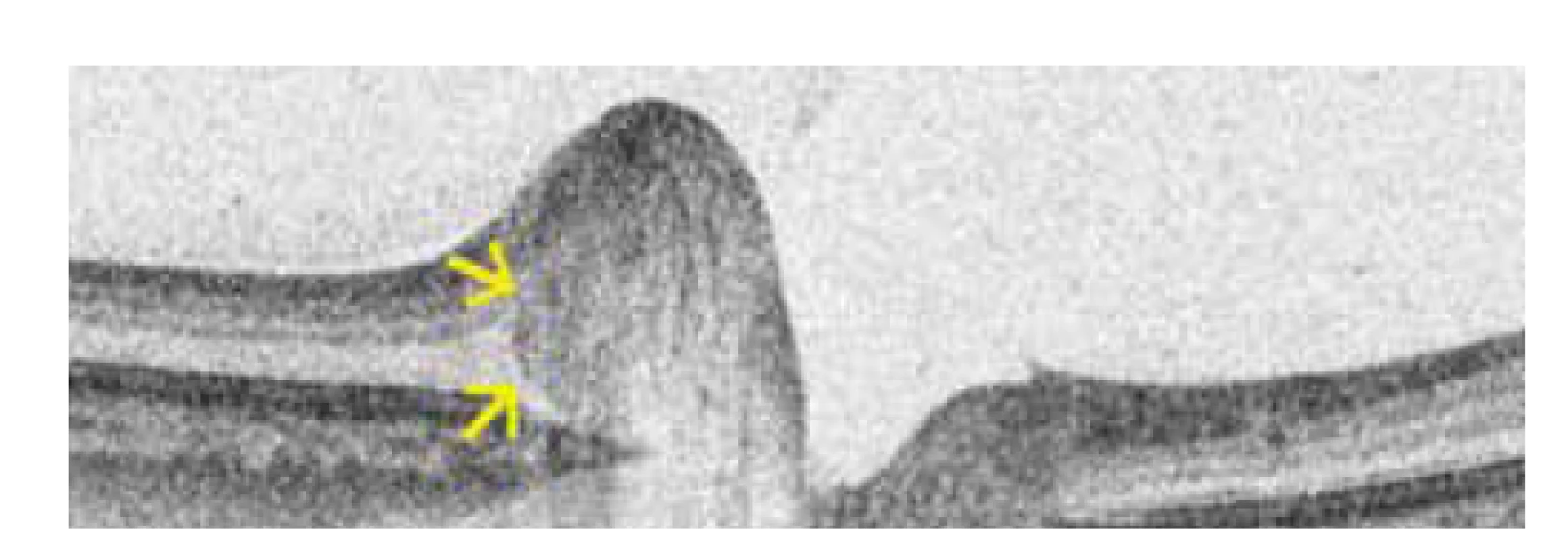 Hyperreflektivní ovoidní léze (anglicky peripapillary
hyperreflective ovoid mass-like structure, zkráceně PHOMS) terče
zrakového nervu u jednoho z našich pacientů. Toto ložisko by nemělo
být označeno jako drúza