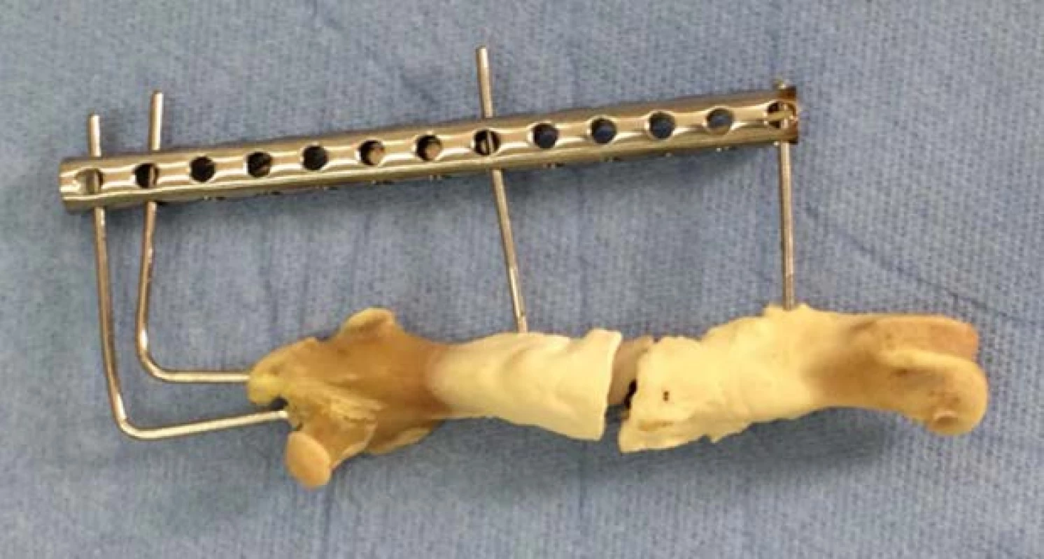 Prepared femur of subject with PEEK implant.