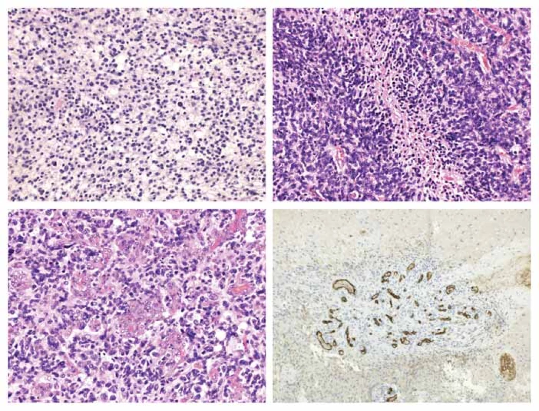 Grading.<br>
A) Cytonukleární atypie a briskní mitotická aktivita u anaplastického astrocytomu.<br>
B) Palisádující nekróza zachycena v glioblastomu.<br>
C+D) Glomeruloidní vaskulární proliferát zastižen u glioblastomu.<br>
D) Imunohistochemické vyšetření exprese CD31.<br>
A–C) Hematoxylin-eozin, původní zvětšení 200×, D) Původní zvětšení 100×