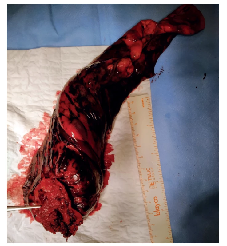 Uniportal VATS, resekovaný horní lalok levé plíce
se 7cm tumorem s en block resekcí terče parietální pleury<br>
Fig. 2: Uniportal VATS, resected upper lobe of the left lung
with a 7cm tumor with en bloc resection of parietal pleura