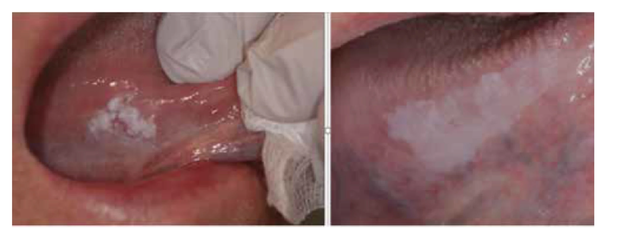 Lézia vpravo: nehomogénna leukoplakia, lézia vľavo: homogénna leukoplakia. Lézie nemigrujú.