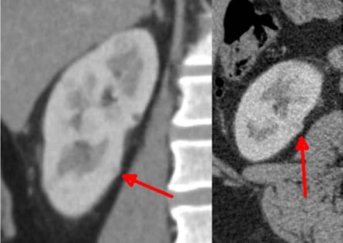 Ložisko velikosti 7 mm, odstraněné jako čtvrté,
bez ischemie<br>
Fig. 4. Lesion of 7mm removed as the fourth one,
without ischemia