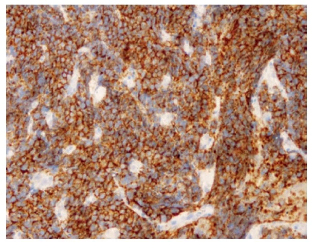 Pozitivita buněk malobuněčného karcinomu v imunohistochemickém
průkazu CD56. 200x.