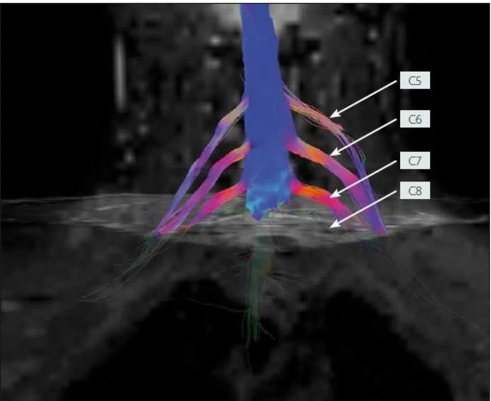 MR traktografie oboustranného brachiálního plexu u zdravého dobrovolníka (žena, 24 let).<br> Fig. 3. MR tractography of the bilateral brachial plexi in a healthy volunteer (female, 24 years).